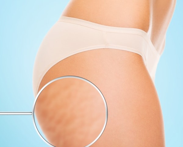 Liposuction and Cellulite
