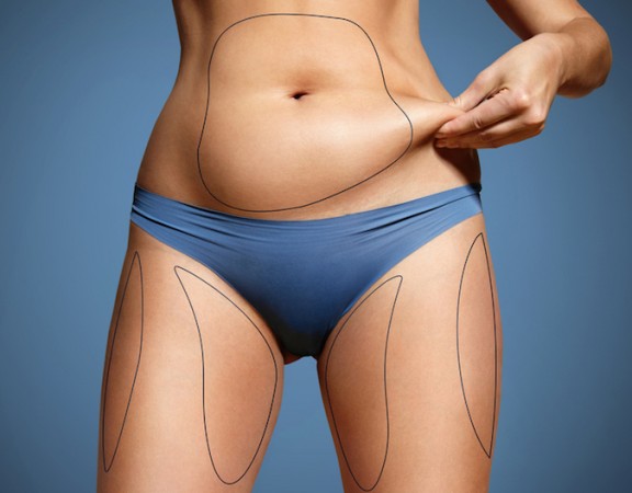 Learn about liposuction