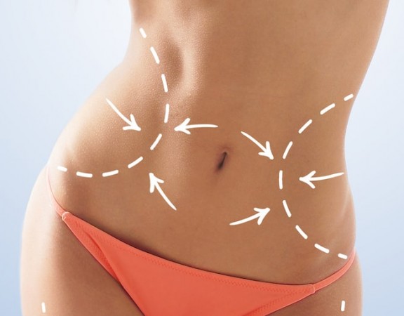 Liposuction and CoolSculpting - Learn about the differences