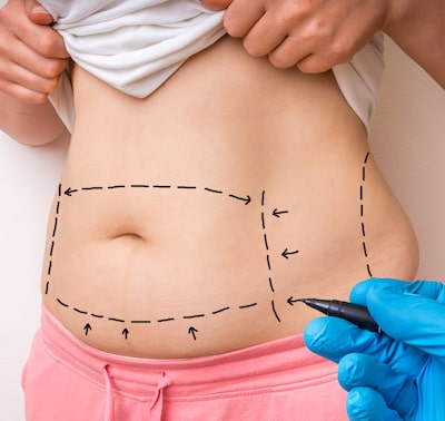 Types of liposuction