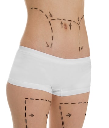 Facts about liposuction