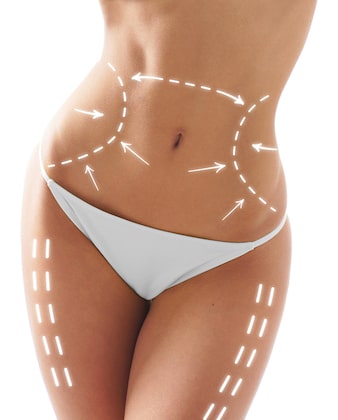 Learn why liposuction became popular