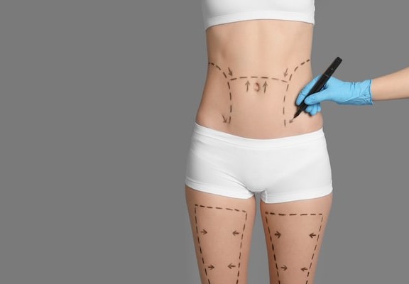 Liposuction Signs of Continued Popularity